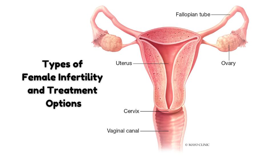 Female Infertility