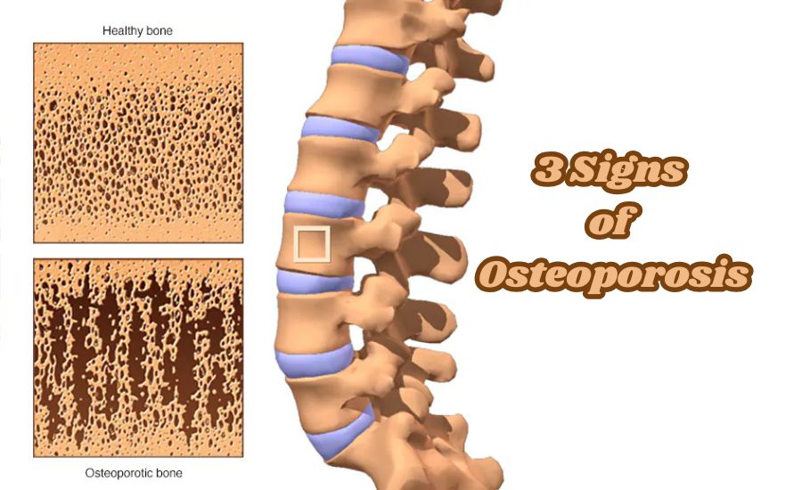 3 Signs of Osteoporosis