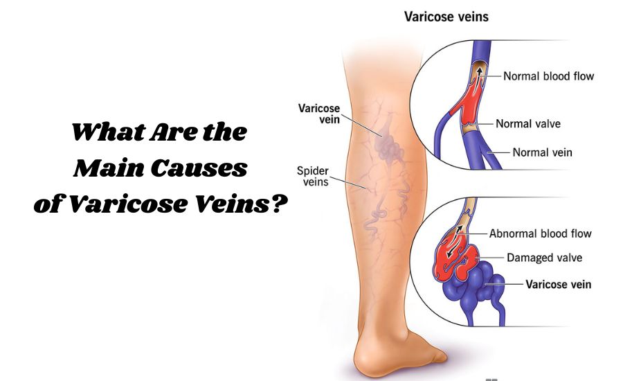 Varicose veins